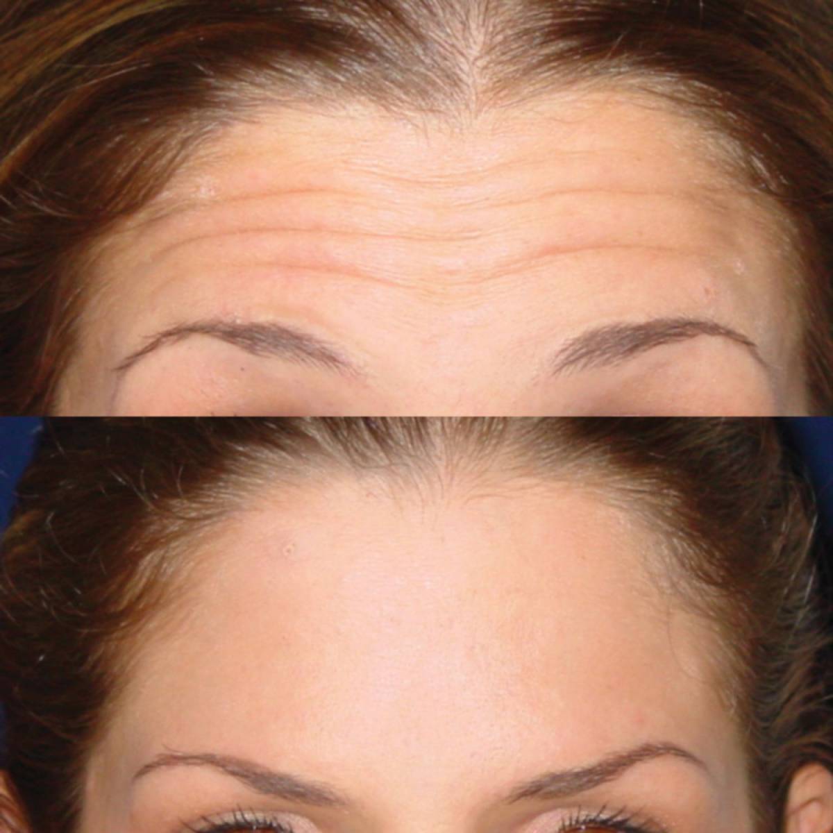 Hiệu quả của việc xóa nếp nhăn trán bằng botox